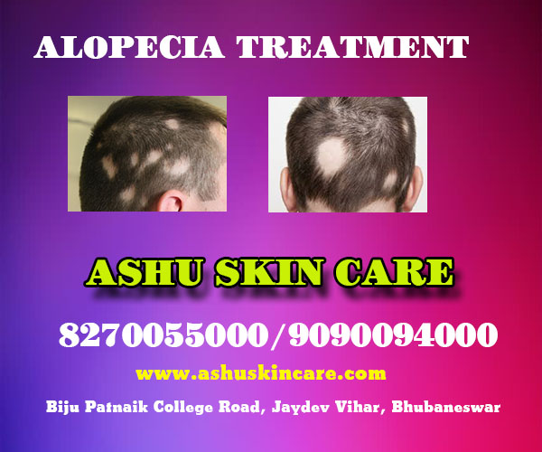 best alopecia treatment clinic  in bhubaneswar close to capital hospital